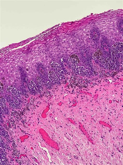 mucosal melanoma pathology outlines